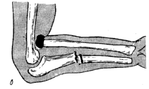 Перелом костей предплечья классификация thumbnail