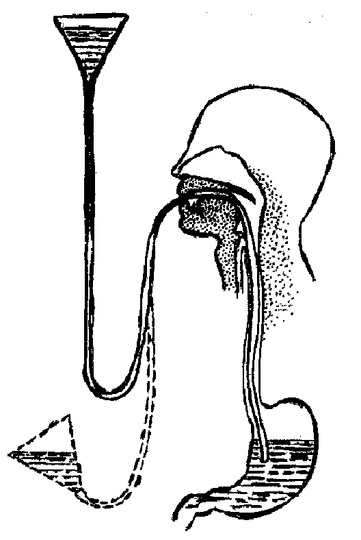 Промывание желудка через зонд
