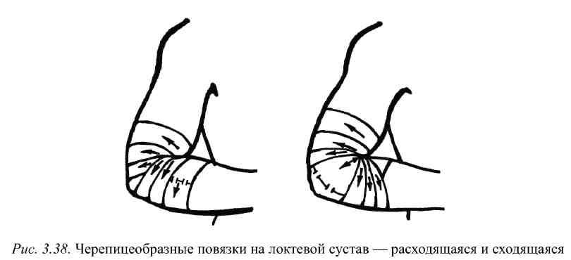 Наложение повязок на различные области тела при кровотечении