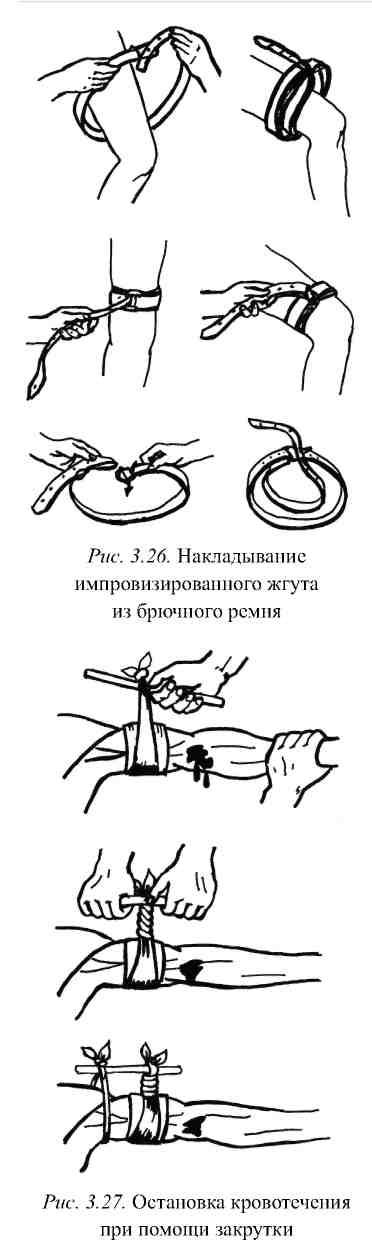 Способ наложения жгута закрутки Способ наложения жгута закрутки