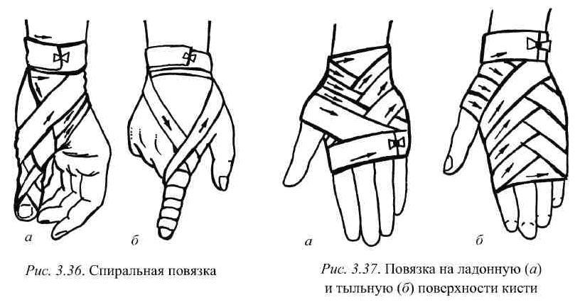 Схемы бинтования рук