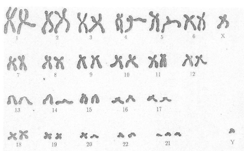 Хромосомные болезни классификация и синдромы