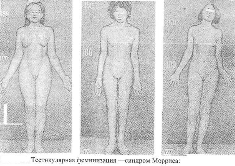 Хромосомные болезни и основные синдромы