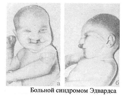 Хромосомные болезни и основные синдромы