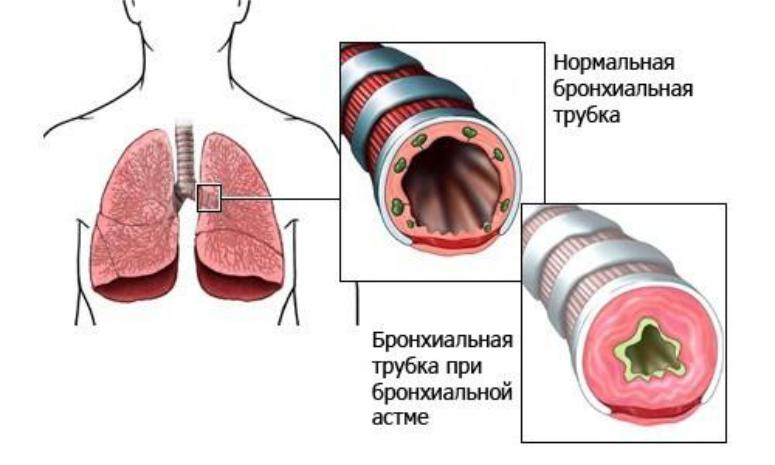 Бронхиальная астма 2014 года thumbnail