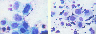Клетки метаплазированного эпителия с реактивными изменениями. Атрофический Тип мазка микроскопия. Метаплазированный эпителий цитограмма. Клетки метаплазированного эпителия в мазке. Клетки метаплазированного эпителия в мазке на цитологию что это.