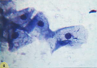 Клетки метаплазированного эпителия с реактивными изменениями. Метаплазированные клетки.
