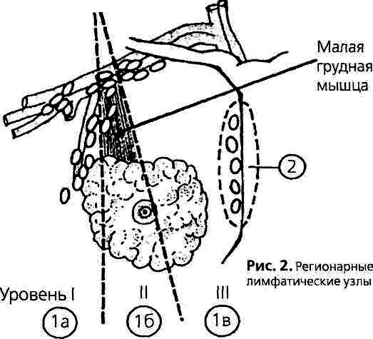 Лимфоотток молочной. Лимфатические узлы молочной железы схема. Регионарные лимфатические узлы молочной. Молочная железа регионарные лимфатические узлы. Уровни лимфатических узлов молочной железы.