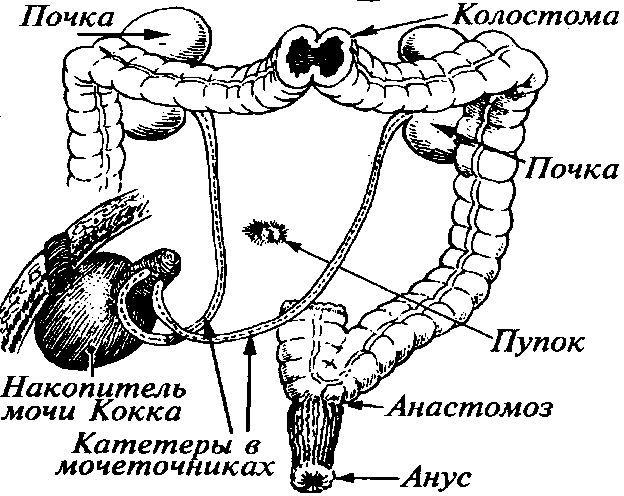 Колостома сигмовидной кишки