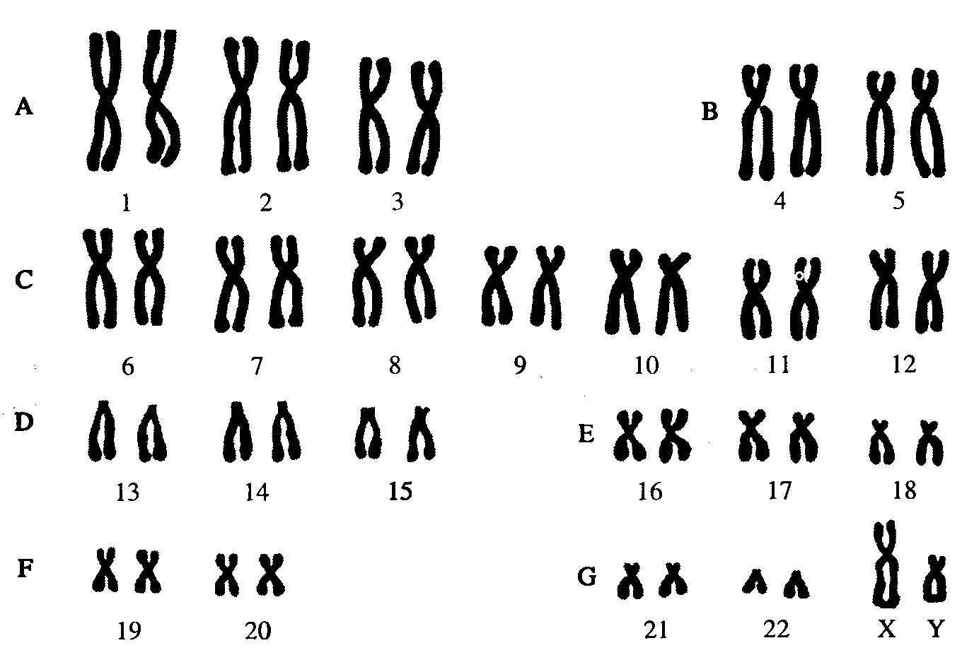 Кариотип человека определяют. Кариотип человека Денверская классификация хромосом. Кариотип человека классификация хромосом человека. Нормальный кариотип человека 46 хромосом. Кариограмма хромосом здорового человека.
