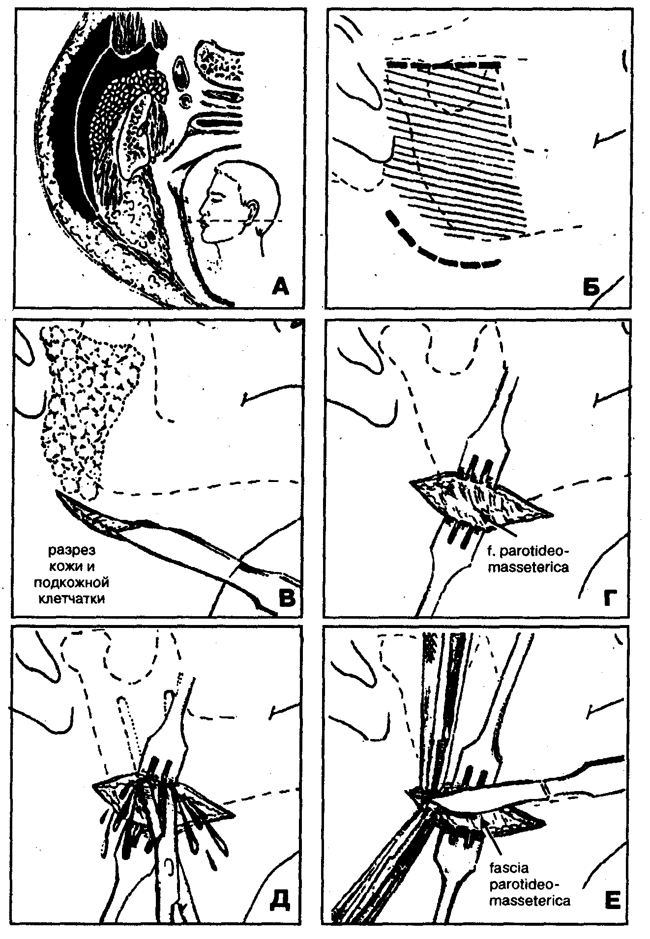 Вскрытие флегмон и абсцессов