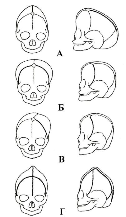 Варианты формы черепа. Краниостеноз формы черепа. Краниоценоз костей черепа. Аномалии развития черепа краниостеноз, башенный череп.
