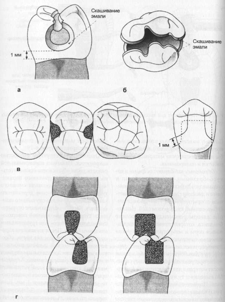 Схемы восстановления боковых зубов светоотверждаемыми композитными материалами