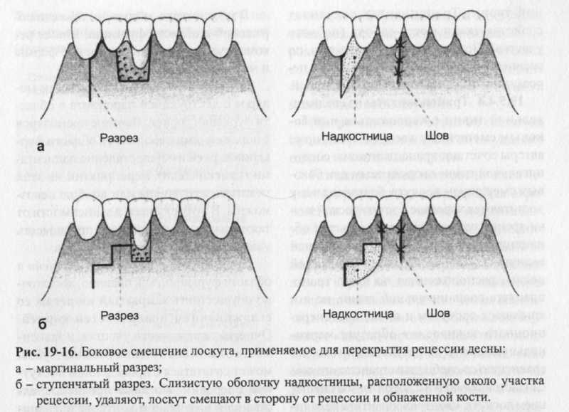 Виды разрезов в хирургии стоматологии