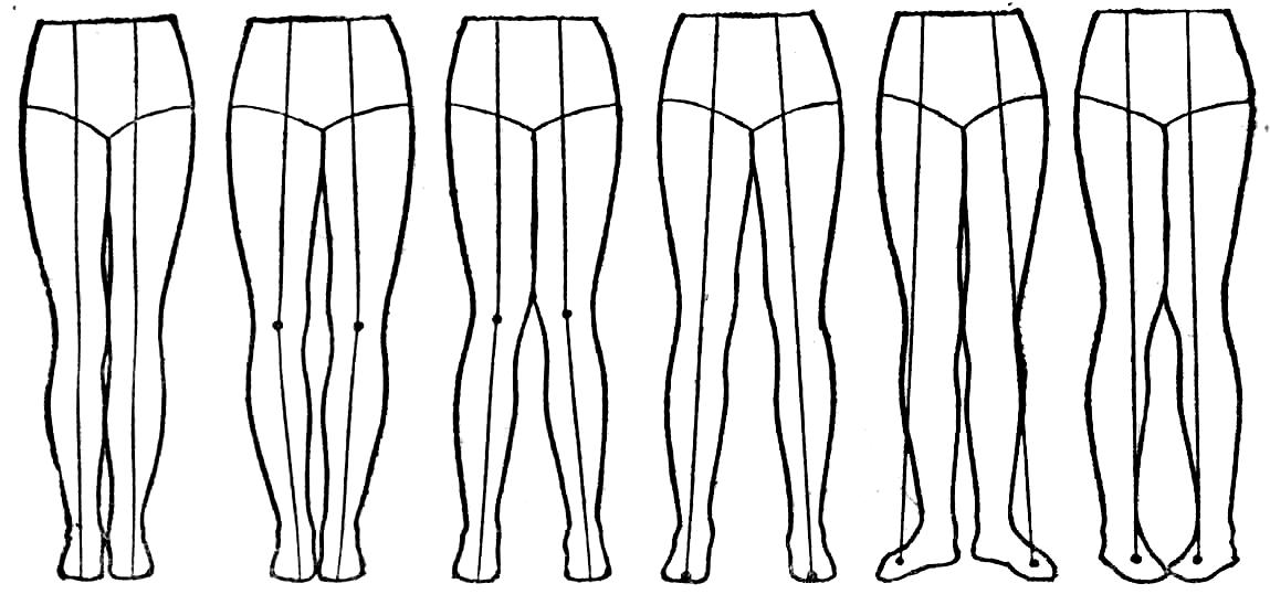 Формы ног. Форма нижних конечностей. Форма ног антропология. Определение формы ног. Типы ног у людей.