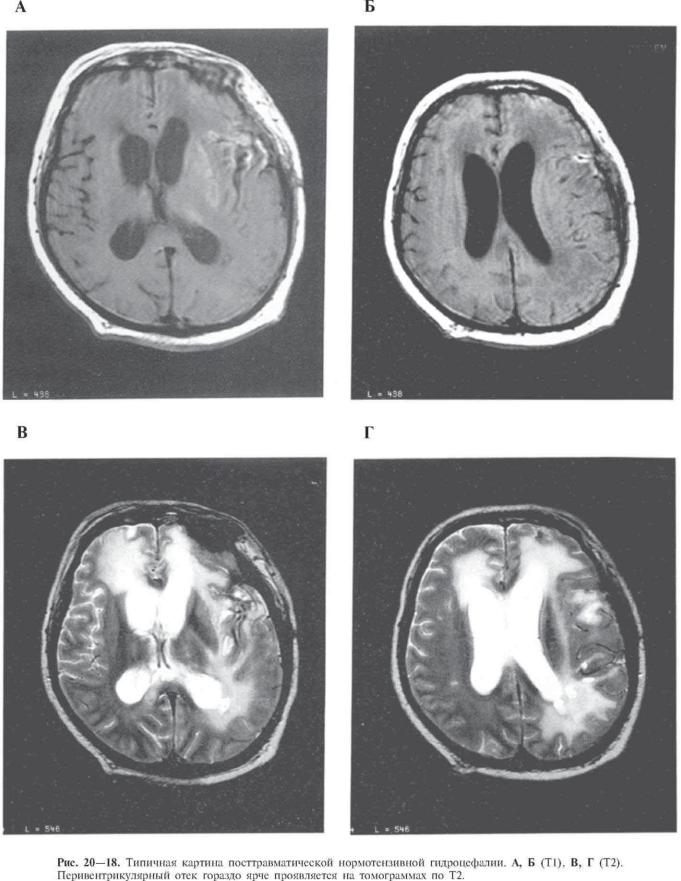Лейкомаляция головного мозга. Перивентрикулярная лейкомаляция кт. Лейкомаляция головного мозга кт. Нормотензивная гидроцефалия мрт. Нормотензивная гидроцефалия кт.