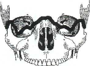 Механизмы и морфология переломов костей черепа