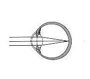 От чего зависит положение глазного фокуса относительно сетчатки
