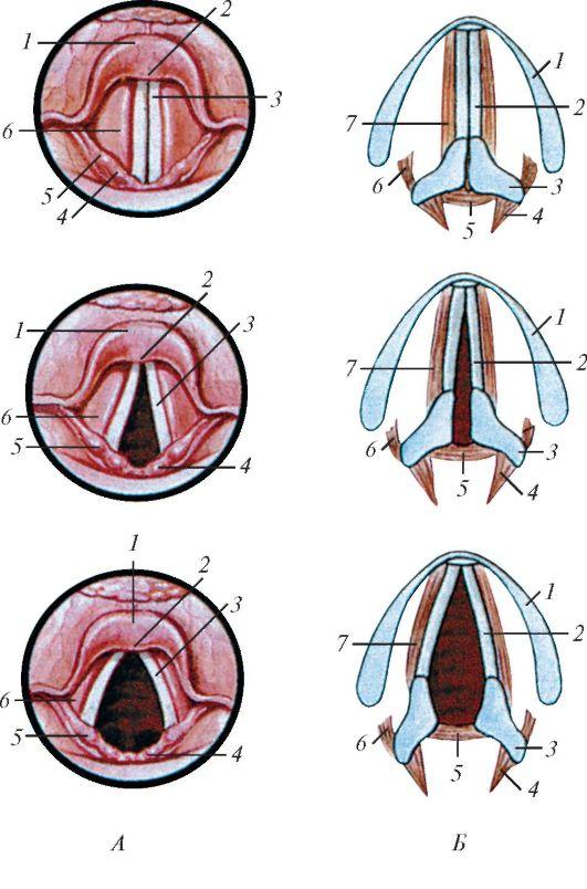 На рисунке изображены различные положения голосовых связок. Узелки голосовых складок ларингоскопия. Пахидермия голосовых складок. Черпаловидные складки гортани. Складки гортани анатомия.
