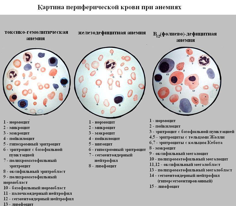 Эритроциты в простате. Микроскопия эритроциты в секрете простаты. Спермограмма лецитиновые зерна. Картина мазка крови при железодефицитной анемии. Картина периферической крови при железодефицитной анемии.