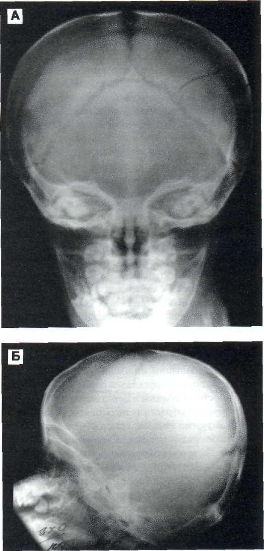 Трещина черепа у ребенка. Вдавленный перелом лобной кости рентген. Оскольчатый перелом черепа рентген. Перелом теменной кости рентген. Перелом костей основания черепа рентген.