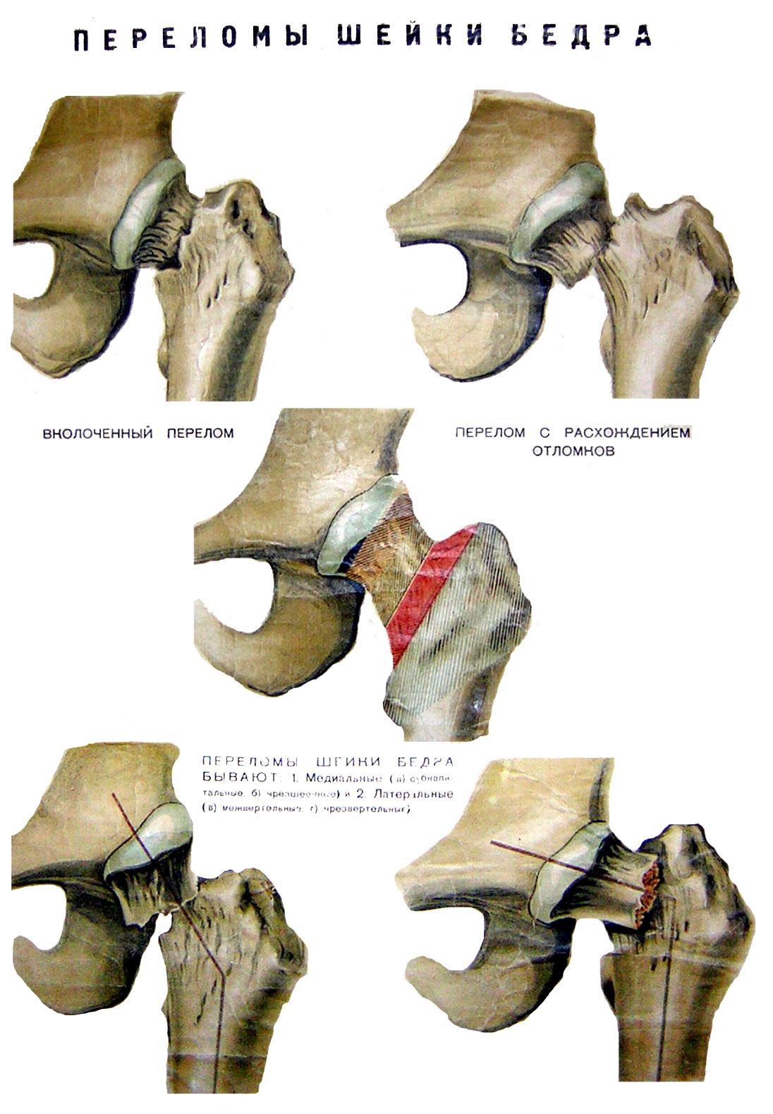Латеральный и медиальный перелом шейки бедра