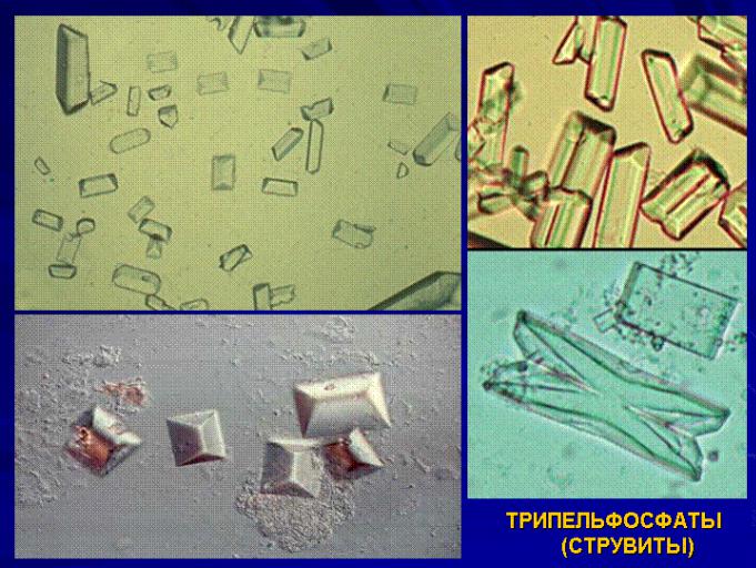 Растворение струвитов. Струвиты трипельфосфаты. Струвиты оксалаты трипельфосфаты. Оксалаты трипельфосфаты. Оксалаты и струвиты микроскоп.
