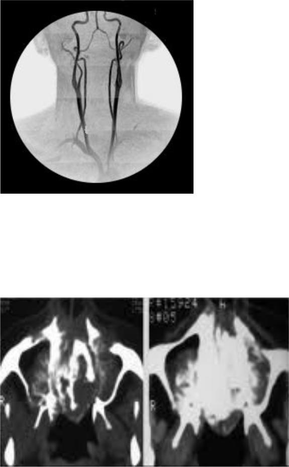 Термограмма больного с острым артритом левого коленного сустава