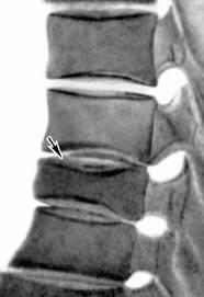 Термограмма больного с острым артритом левого коленного сустава