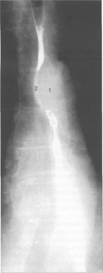 Смещение пищевода рентген. Лучевая анатомия пищевода. Пищевода на рентгенограмме прямая проекция. Короткий пищевод рентгенограмма.