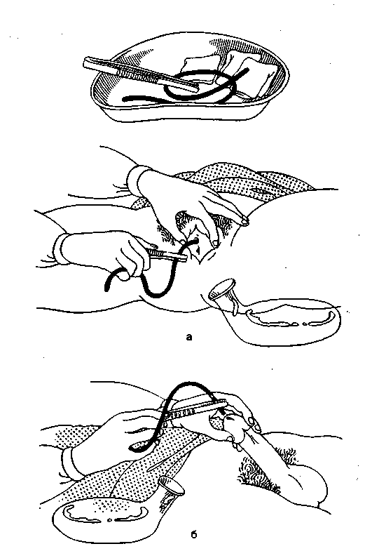 Как поставить мочевой катетер