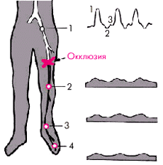 Окклюзия ноги. Окклюзия артерий нижних конечностей УЗИ. Окклюзия артерий нижних конечностей. Окклюзия большеберцовой артерии. Окклюзия берцовых артерий нижних конечностей.