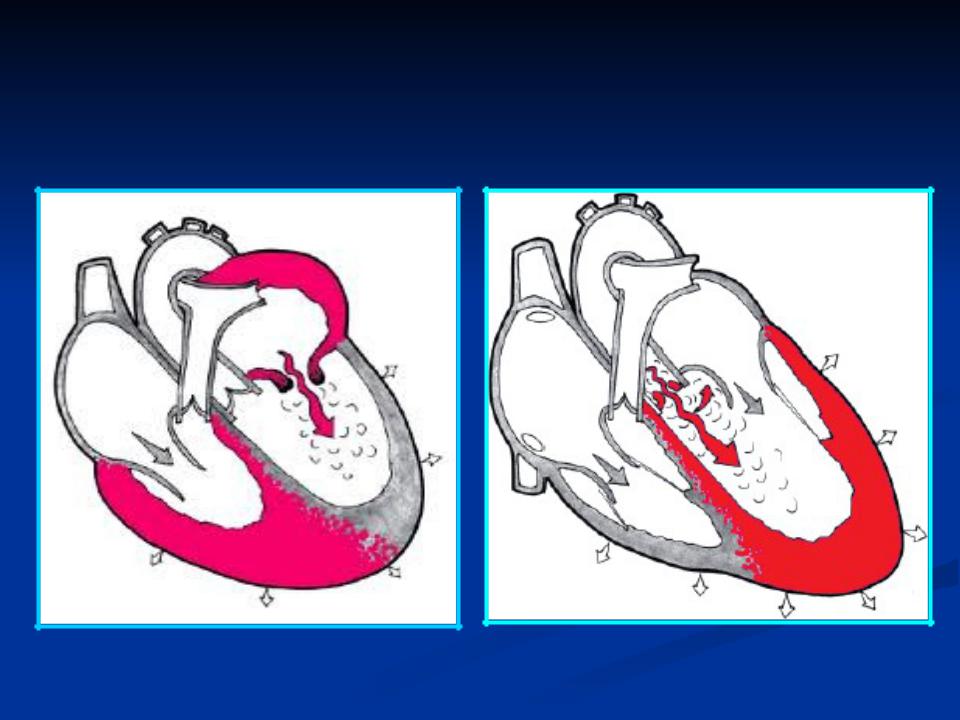 Сердечная недостаточность митрального клапана. Аортальный стеноз и аортальная недостаточность. Аортальный стеноз гемодинамика. Митральный стеноз и недостаточность. Пороки митрального и аортального клапанов.