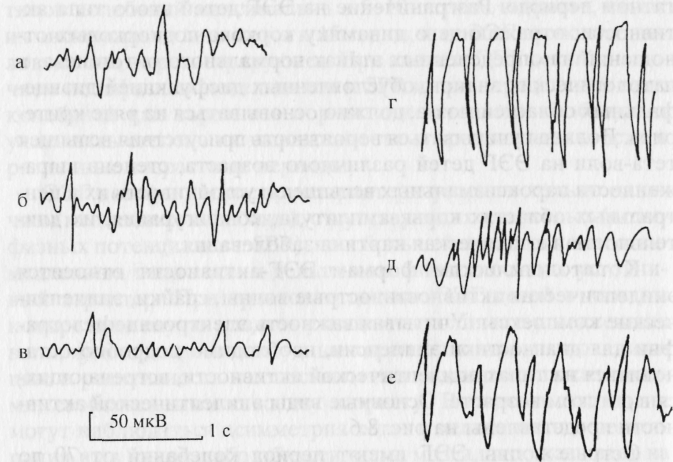 Единичные острые волны. Редуцированный комплекс острая медленная волна. Двухфазные острые волны тета. Форма Альфа волн заостренная с зазубринами. Вспышка острых волн.