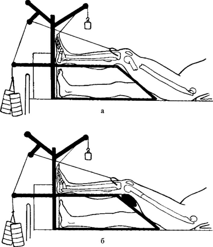 Вытяжение голени. Скелетное вытяжение Беллера. Скелетное вытяжение при переломе бедра. Лейкопластырное скелетное вытяжение. Скелетное вытяжение костей голени.