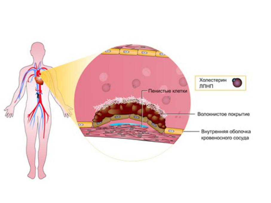 Пенистые клетки образуются. Пенистые клетки атеросклероз. Пенистые клетки. Пустая оболочка человека.