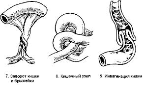 Смешанные формы кишечной непроходимости