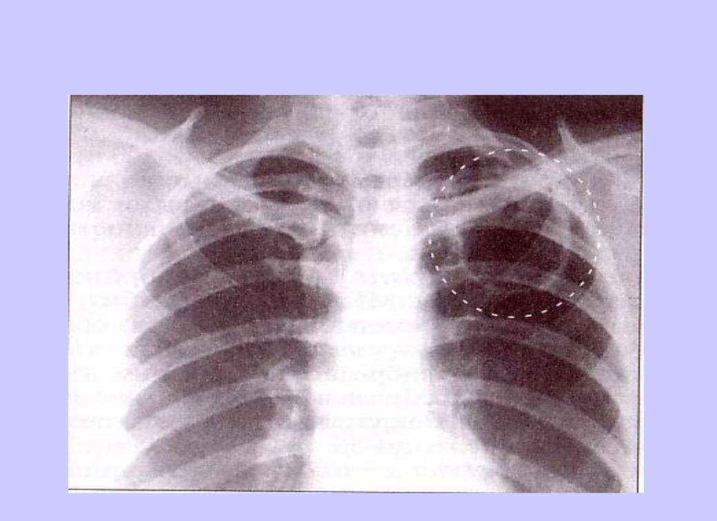 Презентация на тему: Рентгенрограмма №9 Кавернозный туберкулез легких