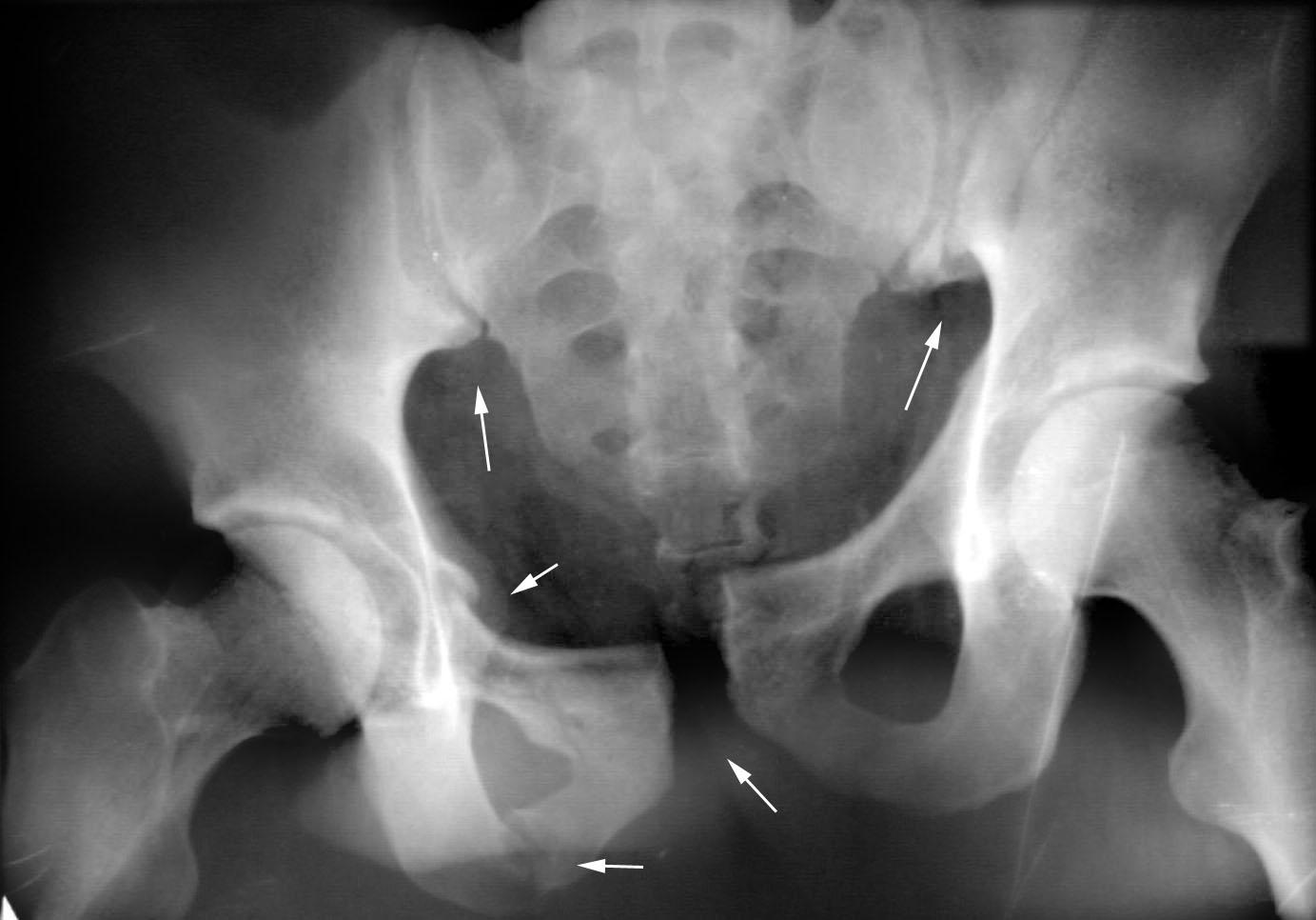 Перелом подвздошной кости рентген