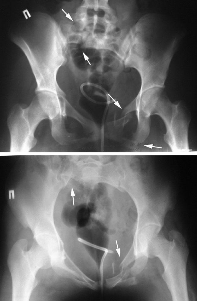 Трещина крестца. Вертикальный перелом крестца рентген. Поперечный перелом крестца s4. Трансфораминальный перелом крестца.