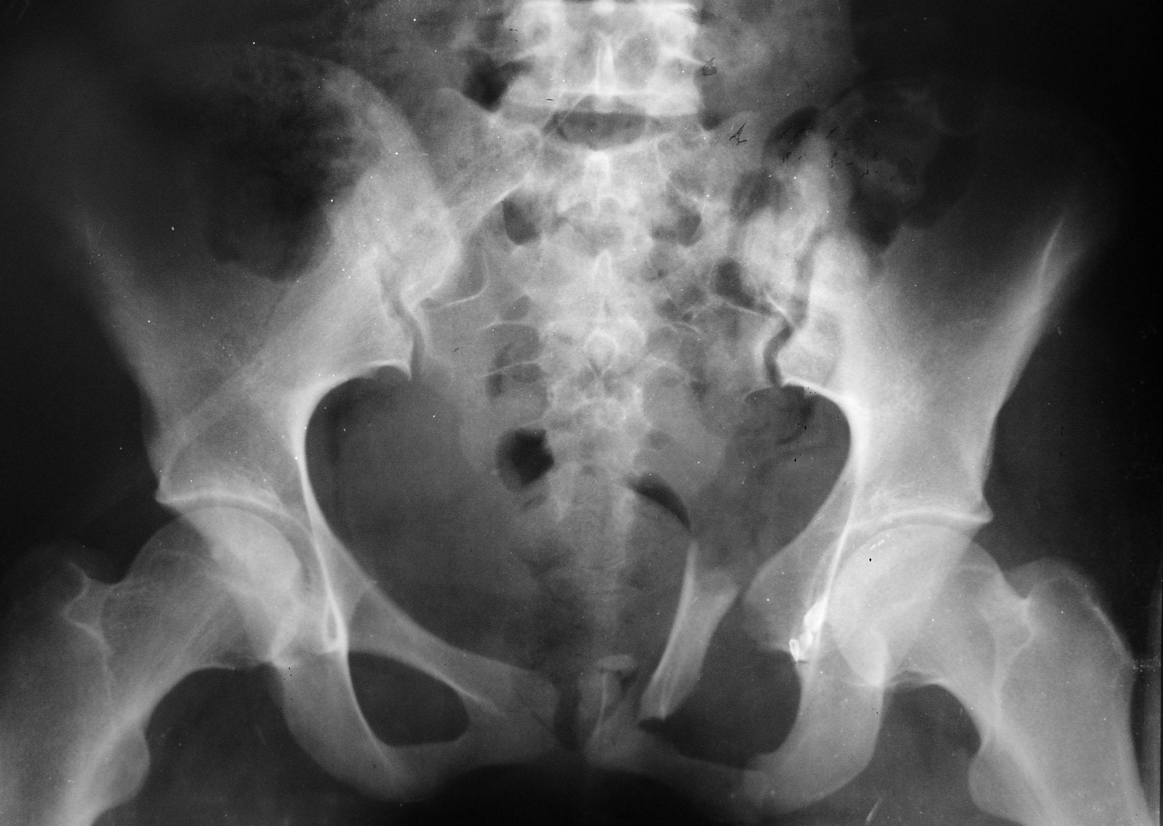 Трещина крестца. Вертикальный перелом крестца рентген. Перелом крестца и копчика рентген. Крестцово-копчиковый отдел позвоночника рентген. Перелом крестца рентген.