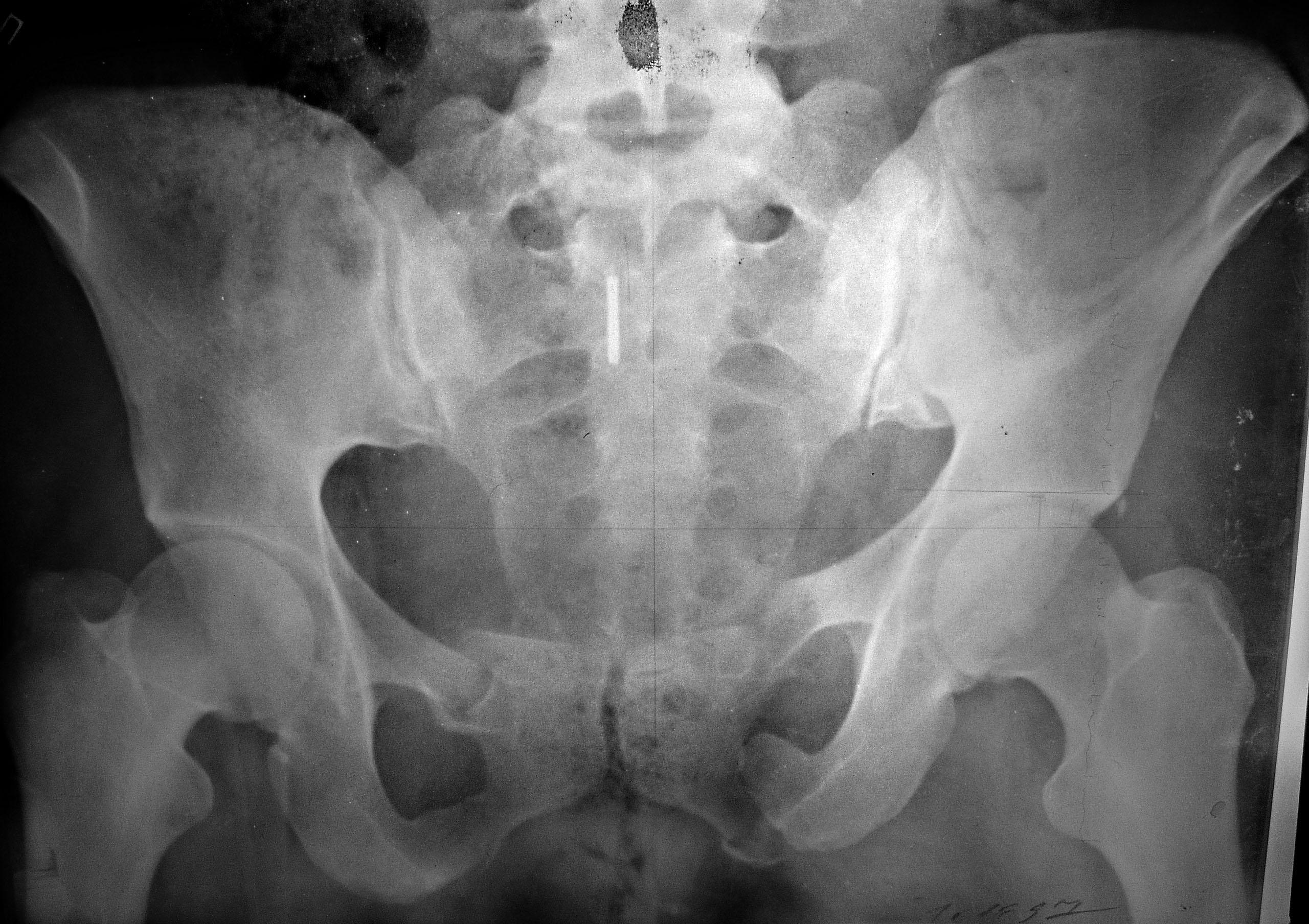 Трещина крестца. Перелом симфиза таза рентген. Краевой перелом подвздошной кости рентген. Перелом Мальгеня таза рентген. Перелом седалищной и лонной кости рентген.
