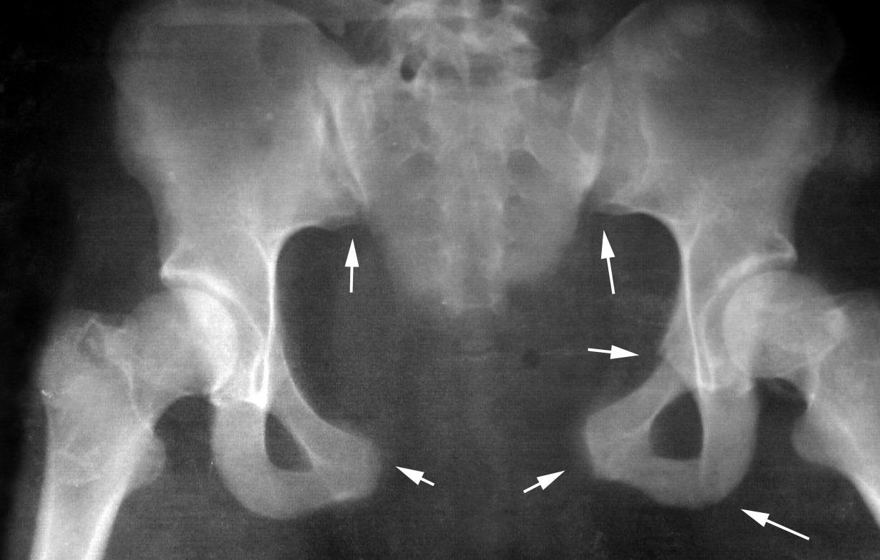 Расширение таза при беременности. Перелом лонного сочленения рентген. Снимок лонного сочленения рентген.