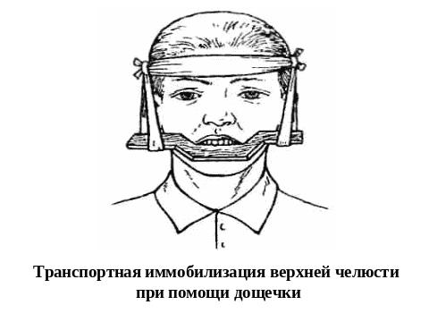 Дифференциальная диагностика перелома верхней челюсти