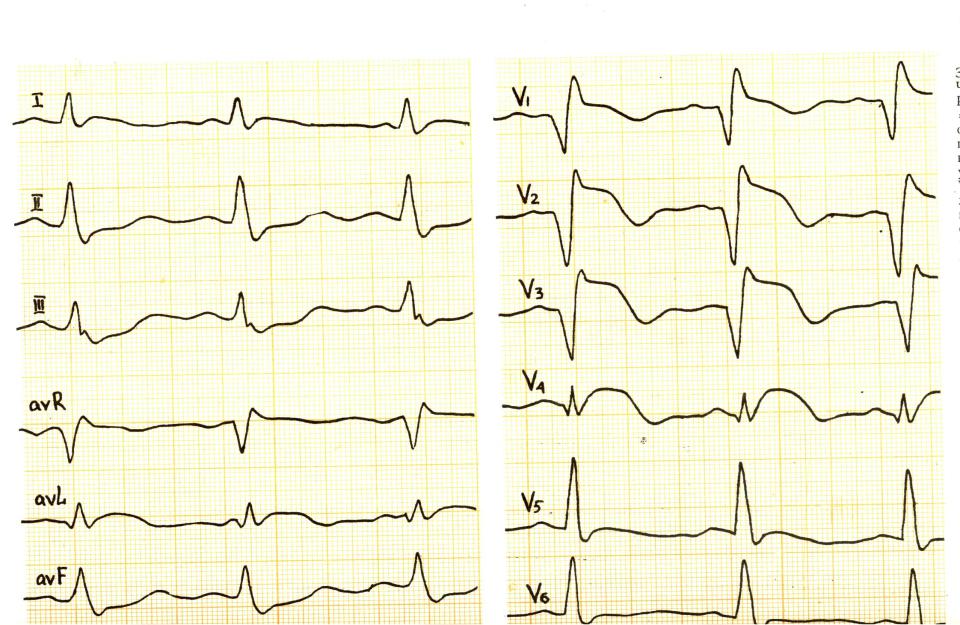 Ишемия на экг фото