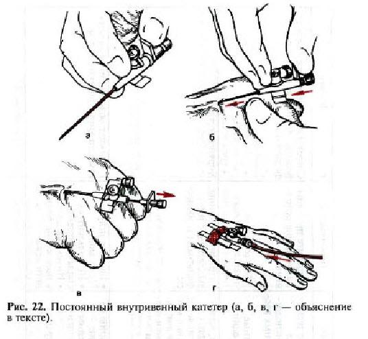 Катетер в вену алгоритм. Техника введения внутривенного катетера. Схема постановки катетера внутривенного. Техника постановки внутривенного периферического катетера алгоритм. Периферический катетер схема.