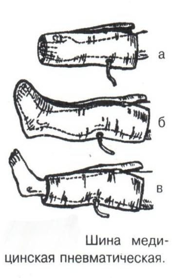Понятие иммобилизация правила иммобилизации виды шин при переломах