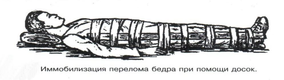 Понятие иммобилизация правила иммобилизации виды шин при переломах