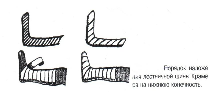 Понятие иммобилизация правила иммобилизации виды шин при переломах