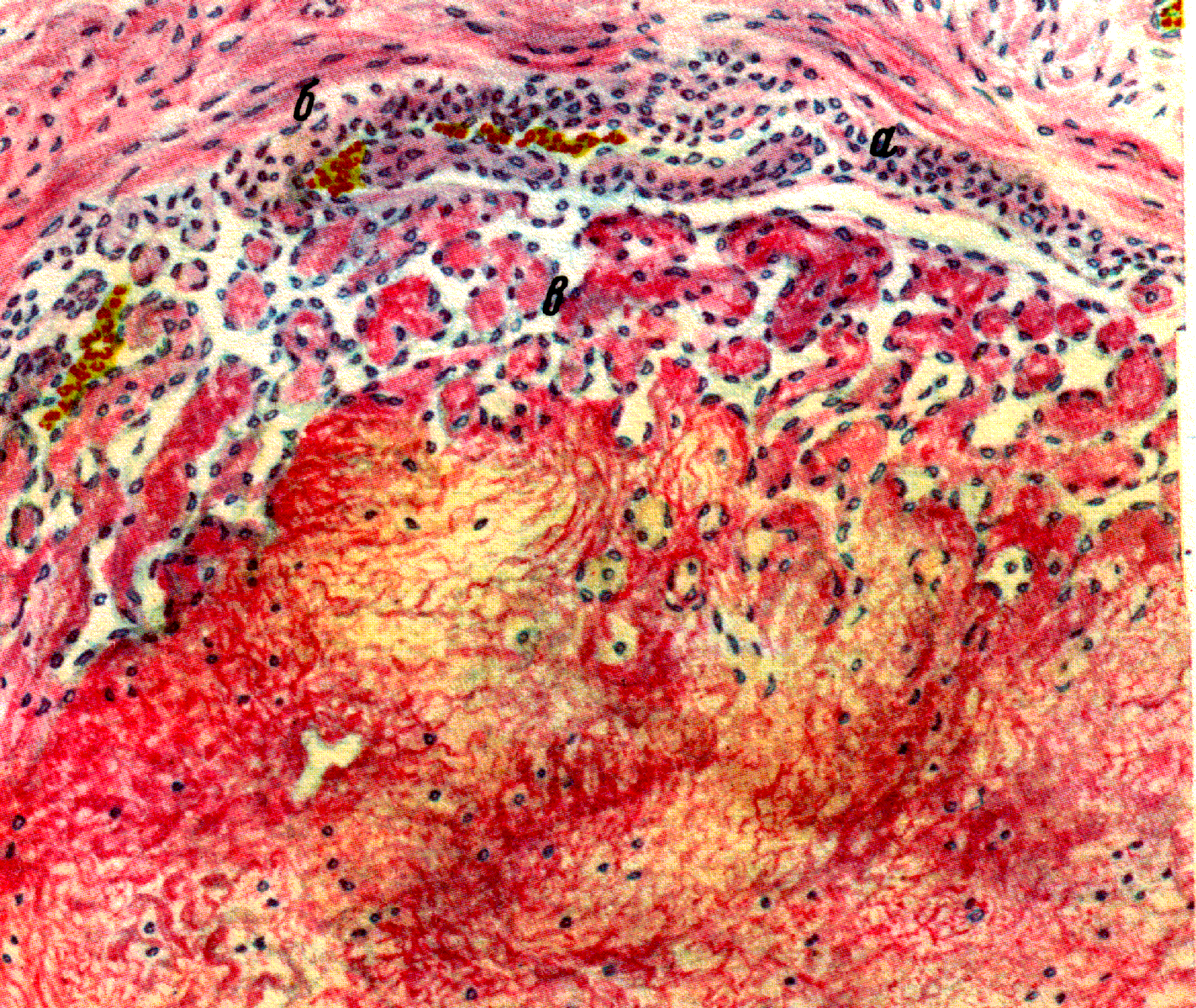 Тромб микропрепарат. Организованный тромб в Вене микропрепарат. Красный обтурирующий тромб микропрепарат. Организованный тромб микропрепарат. Мезотелиома гистология.